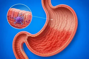Image depicting autoimmune gastritis, showing atrophic fundus with immune cell infiltration